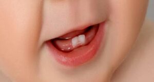 Süt Dişleri Neden Önemlidir?