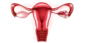 Ektopik (Dış) Gebelik