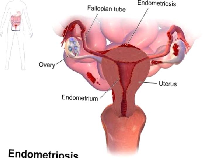Endometriozis’te  Fizyoterapi Seçenekleri