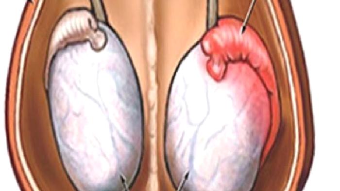 Testiküler Adrenal Rest Tümör