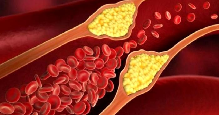 Damar Tıkanıklığı Nasıl Olur?