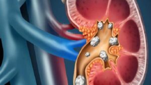 Kronik Böbrek Yetmezliği