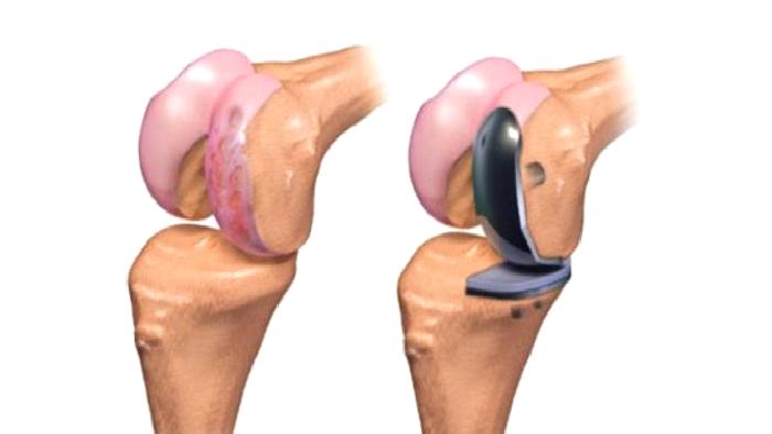 Osteoartrit (Eklem Kireçlenmesi)
