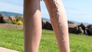 Varis Kapak Kaçağı