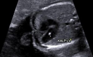 Fetal İntrakardiyak Ekojen Odak Nedir?