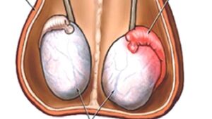 Testis Kanseri Neden Olur?