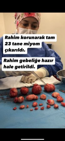 Bursa’da tam 21   adet miyom çekirdeği  rahim korunarak çıkartıldı.