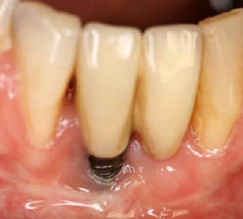 İmplant sonrası ağız hijyeni ve peri-implantitis