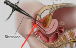 Kadınlarda idrar yolu (üretra) darlığı