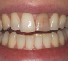 Kanal tedavili dişlerde renklenme