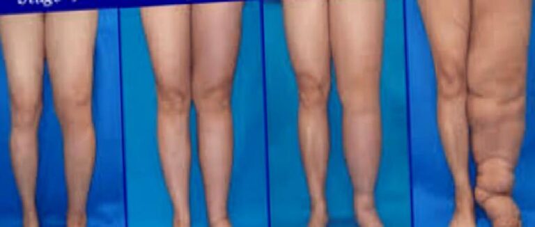 Lenfödem ve lipödem de bacakda şişlik yapar mı?