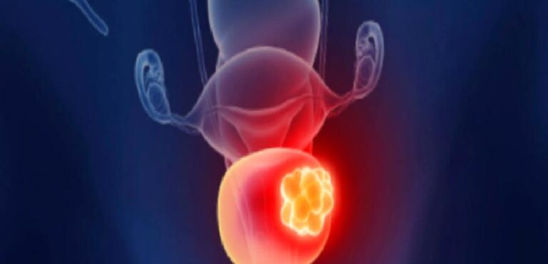 Mesane kanseri hakkında