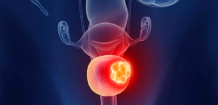 Mesane kanseri tedavisi