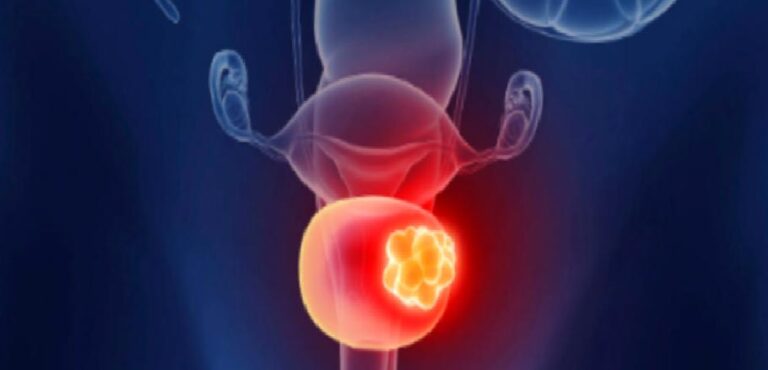 Mesane kanserinde olası nedenler ve koruma