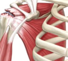 Omuzda kas yırtığı (rotator cuff yırtığı) hakkında bilmeniz gereken her şey
