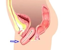 Rahim sarkması ve tedavi yöntemleri