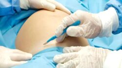 Sezaryen sırasında myom ameliyatı: riskler, faydalar ve dikkat edilmesi gerekenler