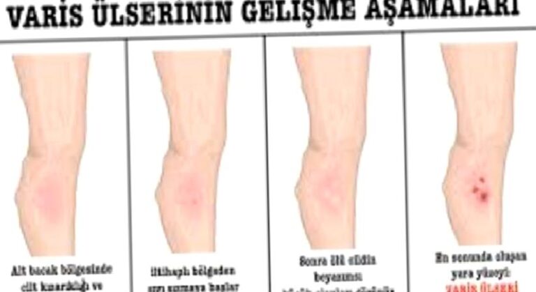 Varis yarası