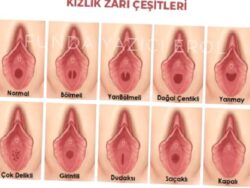 Kızlık zarı dikimi: himenoplasti