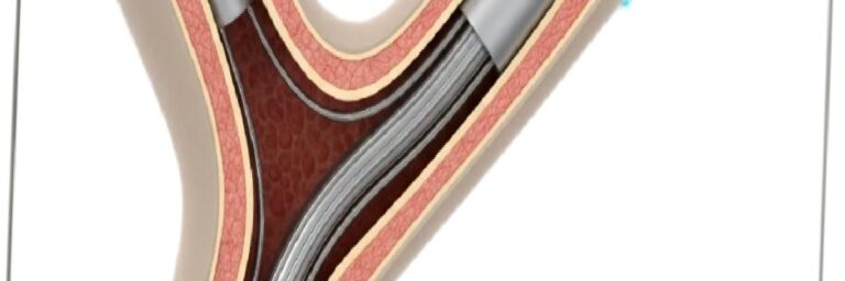 A Permanent Solution to Erectile Dysfunction: What Is a Penile Implant?