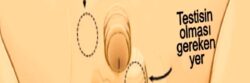 İnmemiş testis (kriptorkidizm) ve asansör testis (retraktil testis) nedir?