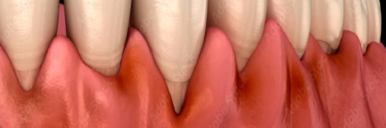 DİŞ ETİ HASTALIKLARI