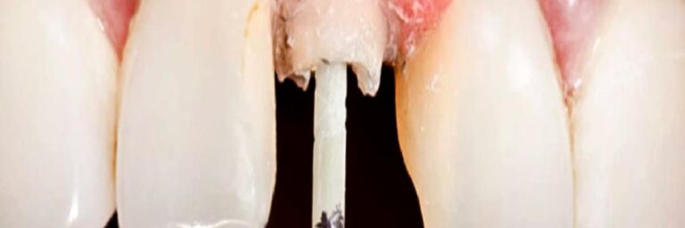 KANAL İÇİ FİBER POST (ÜST KISMI TAMAMEN ÇÜRÜMÜŞ DİŞLERİN KURTARILMASI)