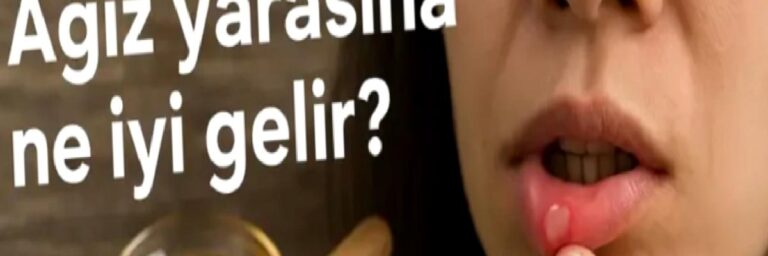 Ağız yarasına ne iyi gelir