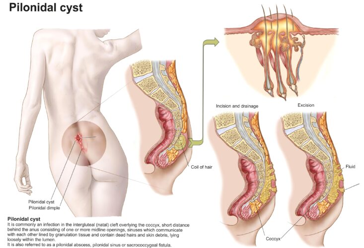 Kıl Dönmesi Hastalığının İlk Belirtileri Nelerdir?
