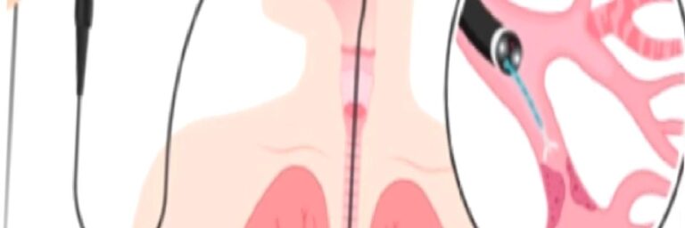 Endobronşiyal Ultrason (EBUS): Akciğerlerin Gizemli Dünyasına Yolculuk