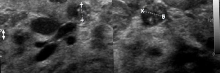 Fibroadenom ile Meme Kanseri İlişkisi