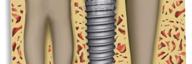 Dental ( Dişle ilgili) İmplantlar