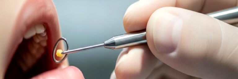 Samsun’da Bademcik Taşı (Tonsillolit) Tedavisi