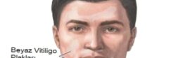 Vitiligo ( Ala Hastalığı )