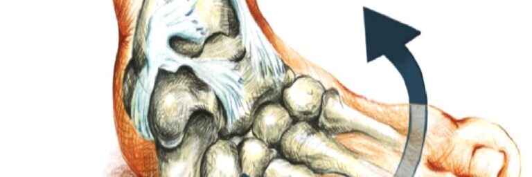 Ayak bileği burkulması nedir?