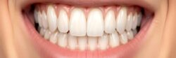Estetik Diş Kaplamaları