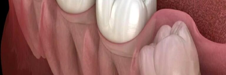 Gömülü 20 yaş dişleri neden çekilmeli midir?