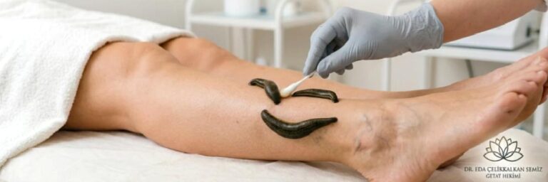 HİRUDOTERAPİ VE TIP
