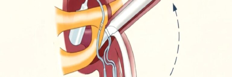 Penil Protez: Nedir, Nasıl Çalışır ve Kimler İçin Uygundur?