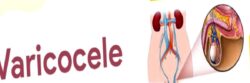 Varikosel: Sessizce İlerleyen ve Erkek Fertilitesini Tehdit Eden Damar Sorunu
